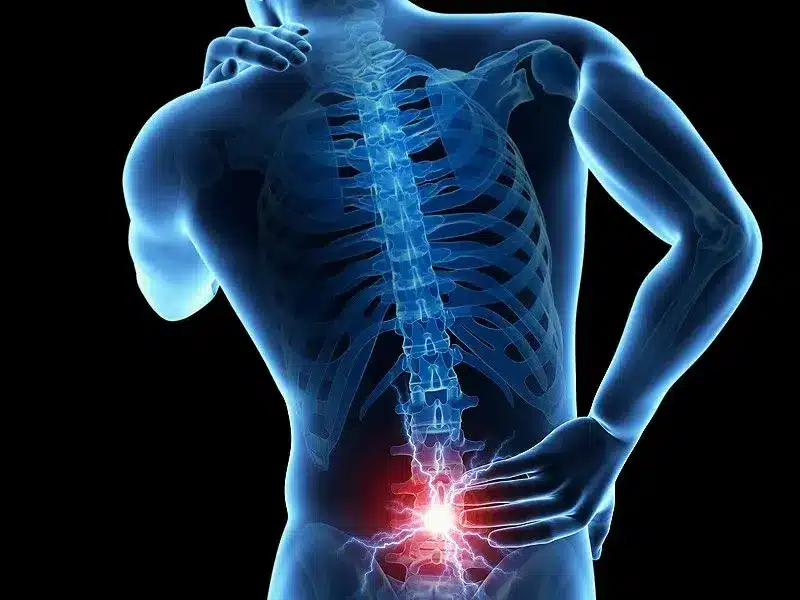 Ilustraci&oacute;n de rayos X del dolor de espalda baja (lumbar) por una lesi&oacute;n de accidente de auto