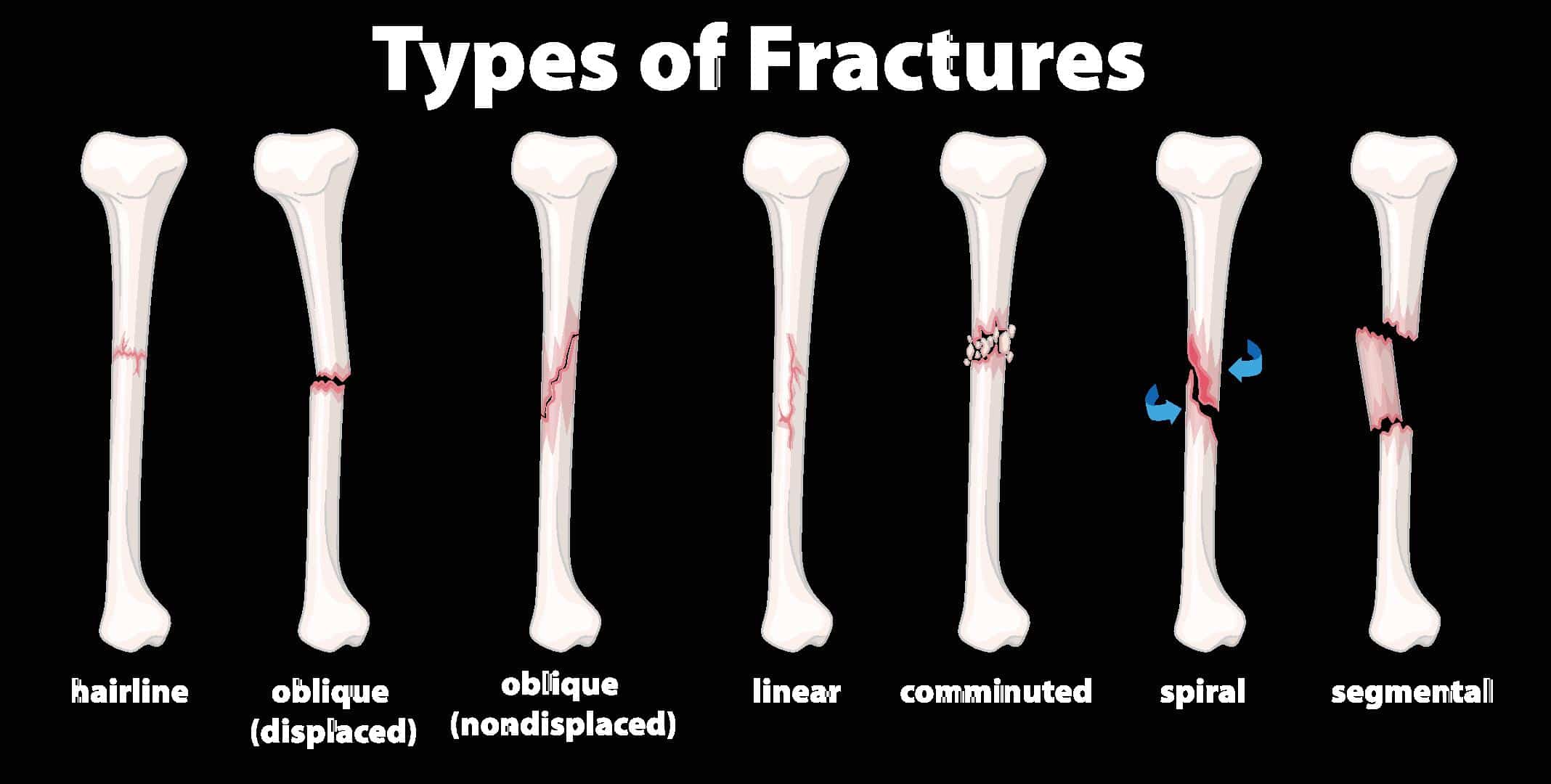 Diagram of common bone fracture types &mdash; hairline, oblique displaced and non-displaced, linear, comminuted, spiral, and segmental