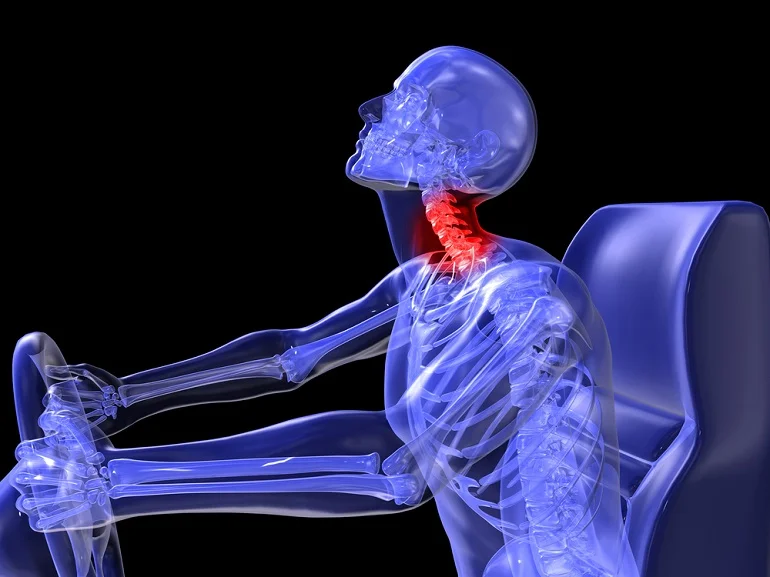 Ilustraci&oacute;n de rayos X de un conductor con una lesi&oacute;n de latigazo cervical tras un accidente de auto